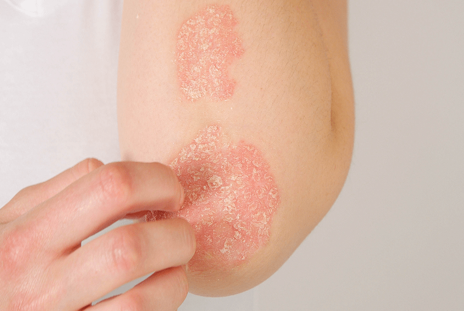 psoriasis patch on elbow